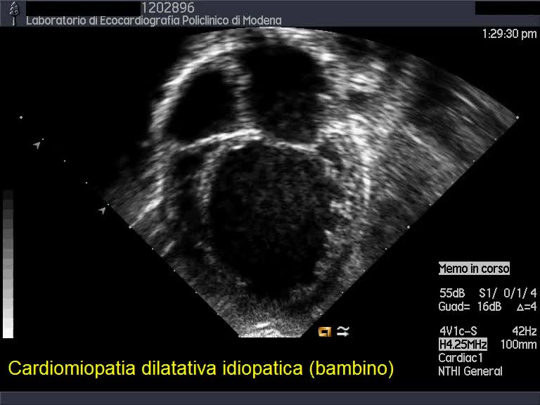 Cardiomiopatia ipocinetico dilatativa