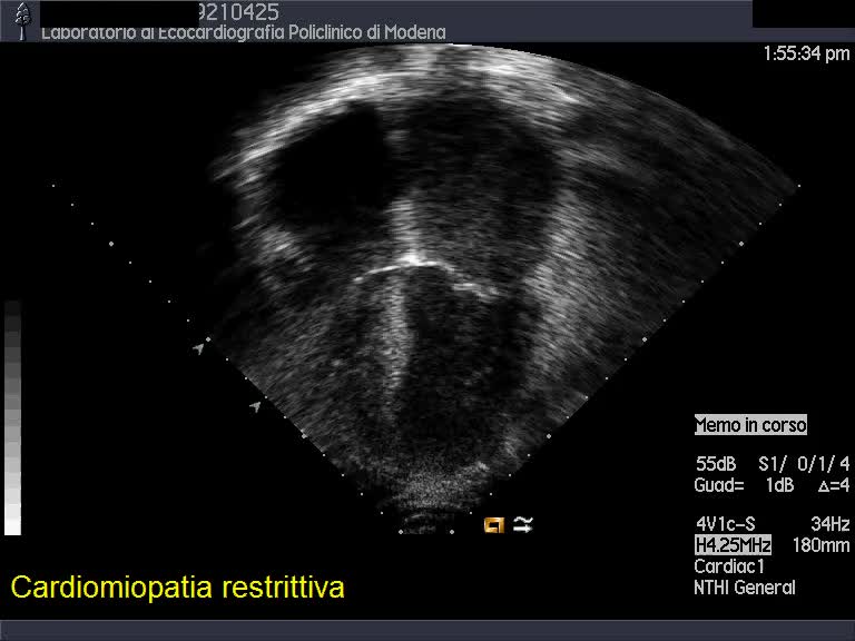 Cardiomiopatia restrittiva
