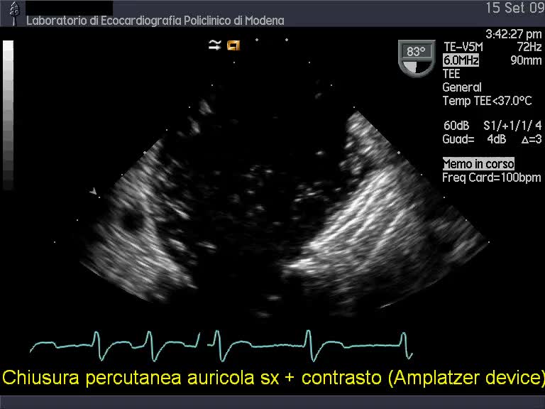 Auricola sinistra chiusura