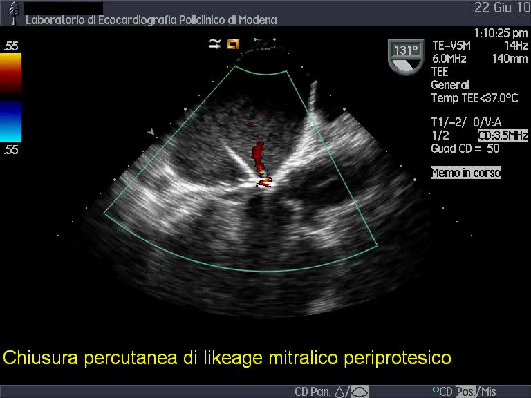 Chiusura percutanea di paraleak (protesi valvolare mitralica biologica)