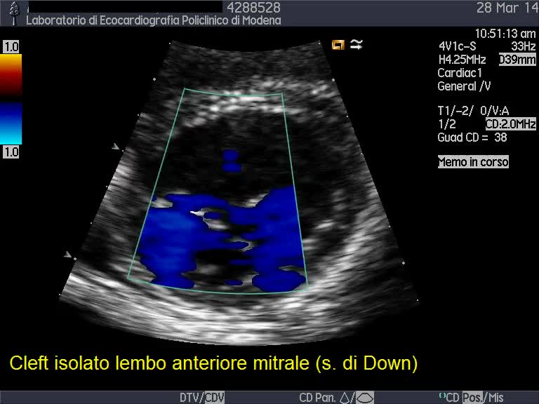 Cleft del lembo anteriore mitralico
