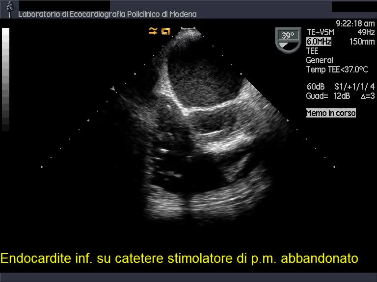 Endocardite infettiva su elettrocatetere stimolatore abbandonato