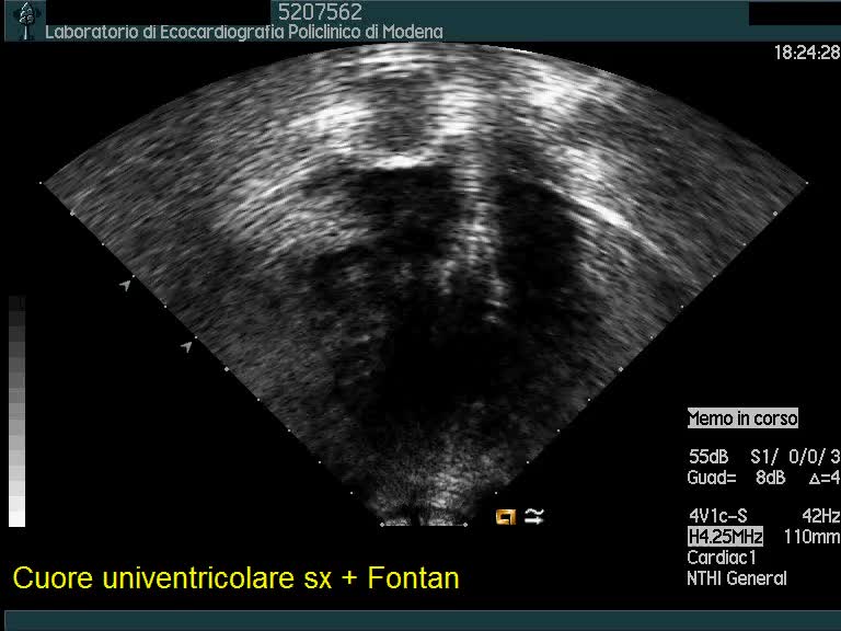 Cuore univentricolare