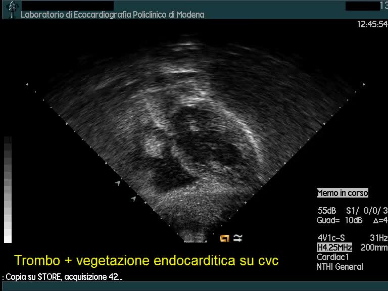 Vegetazioni su catetere