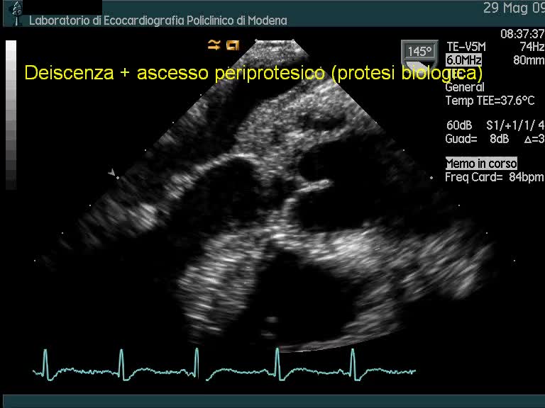 Vegetazioni su protesi aortica biologica con ascesso periprotesico