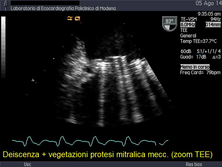 Vegetazioni e distacco di protesi valvolare mitralica meccanica