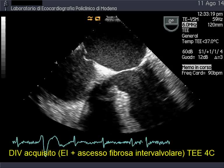 Ascesso della porzione mitroaortica e conseguente div perimembranoso