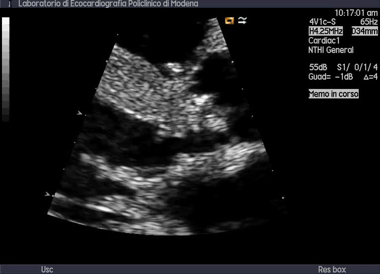 Vegetazioni sul setto interventricolare membranoso e ascesso