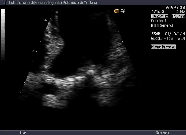 Vegetazione su anello mitralico in esiti di plastica