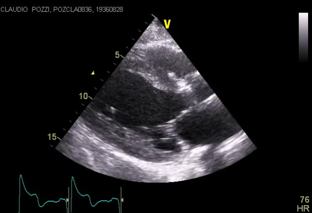 Falso tendine disancorato