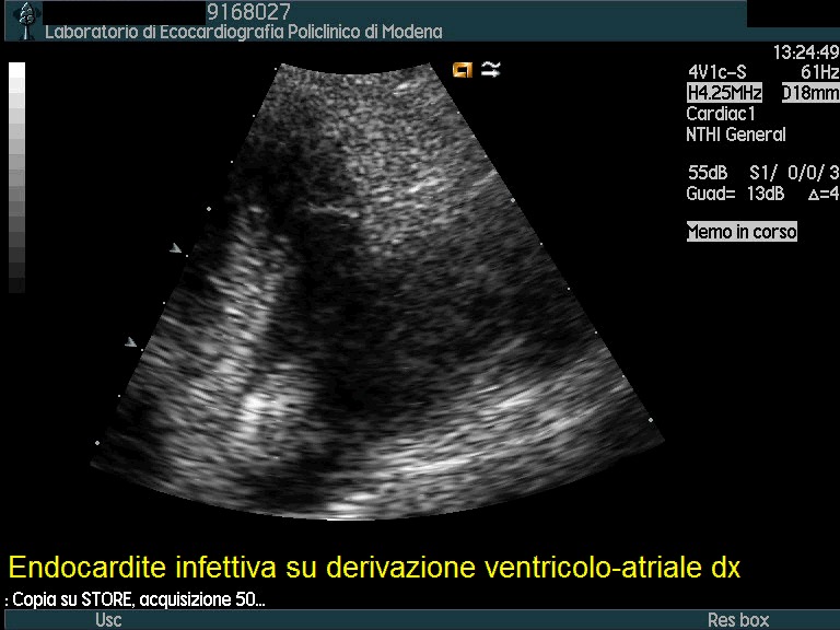 Endocardite su derivazione ventricolo-atriale destra