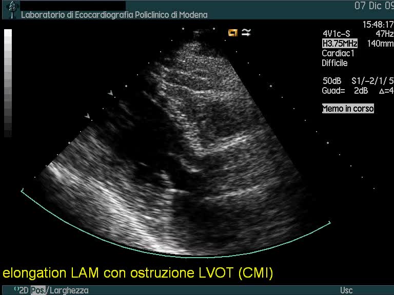 Cardiomiopatia ipertrofica ostruttiva con “elongation” del lembo anteriore della mitrale e severo sam