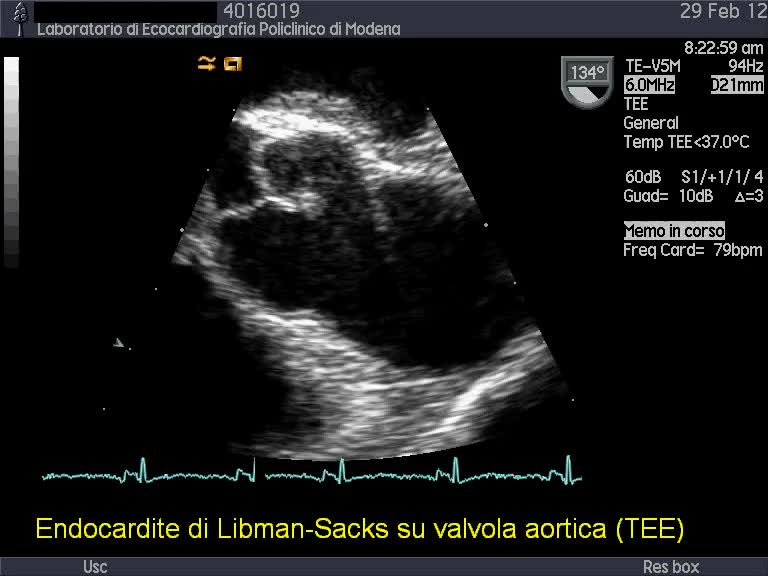 Endocardite non-infettiva: vegetazioni di Libman-Sacks