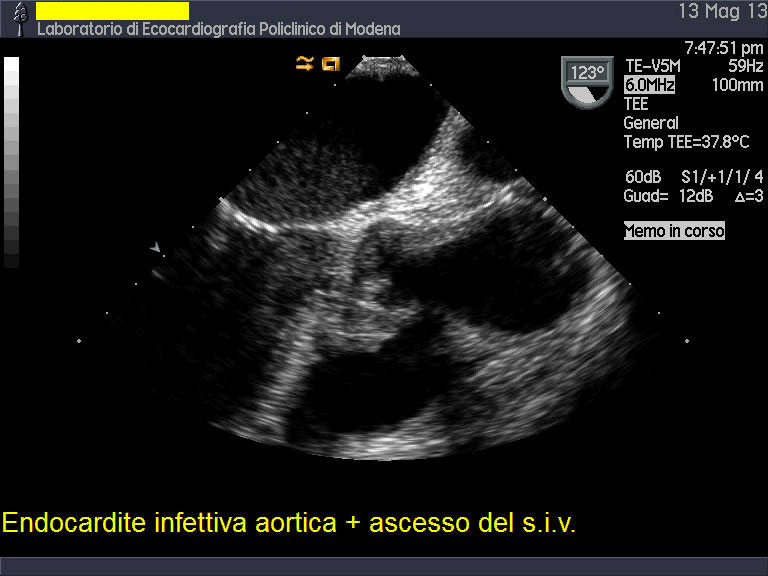 Endocardite su mitrale