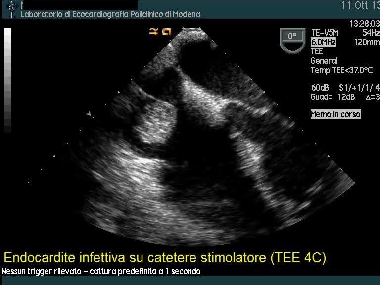 Endocardite infettiva su elettrocatetere stimolatore