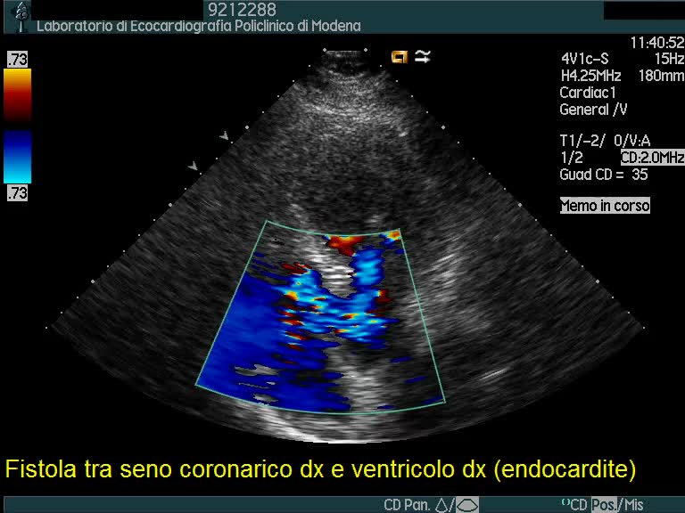 Endocardite infettiva complicata da fistola tra seno coronarico destro e ventricolo destro