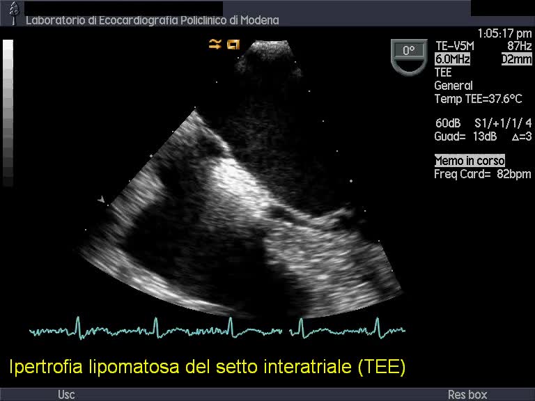 Ipertrofia lipomatosa del setto interatriale