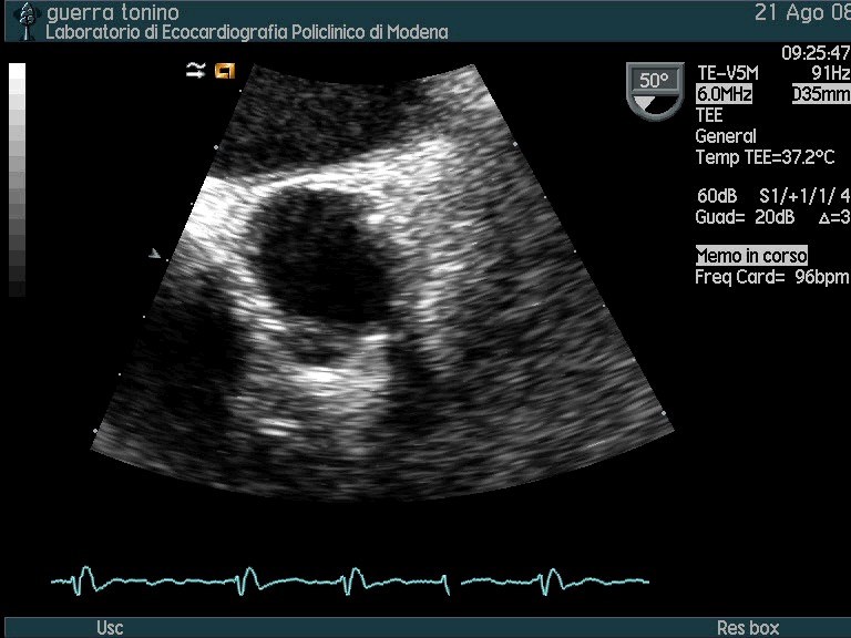 Protesi aortica meccanica malfunzionante