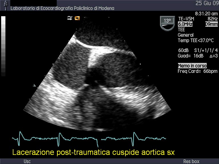 Insufficienza valvolare aortica acuta post-traumatica