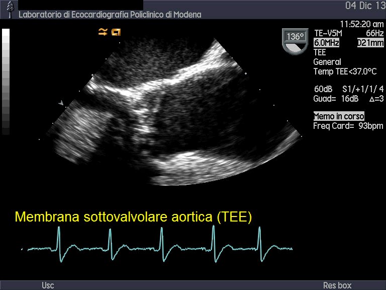 Stenosi sottovalvolare aortica