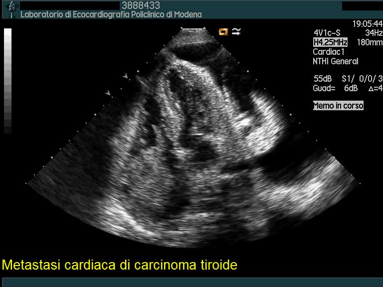Metastasi cardiaca di carcinoma tiroideo