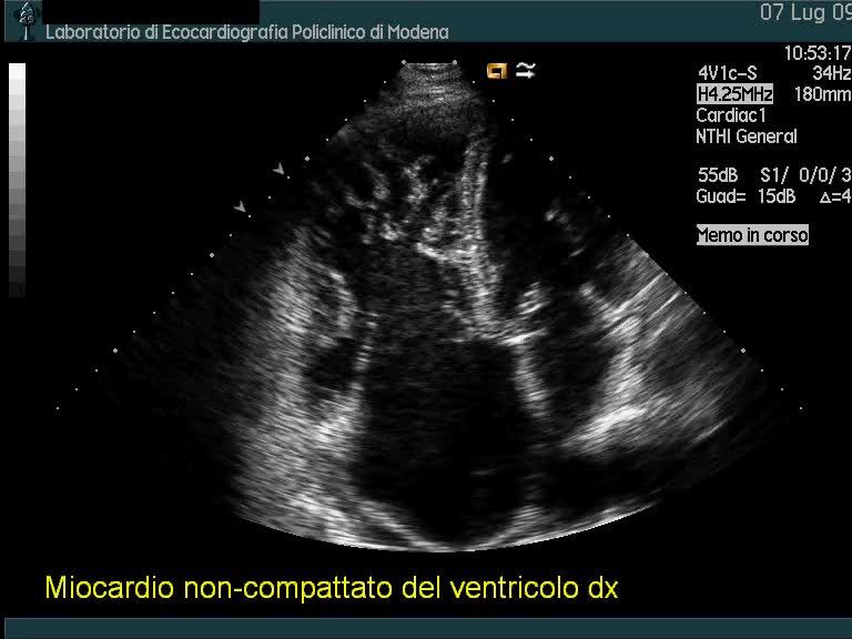 Miocardio non-compattato del ventricolo destro