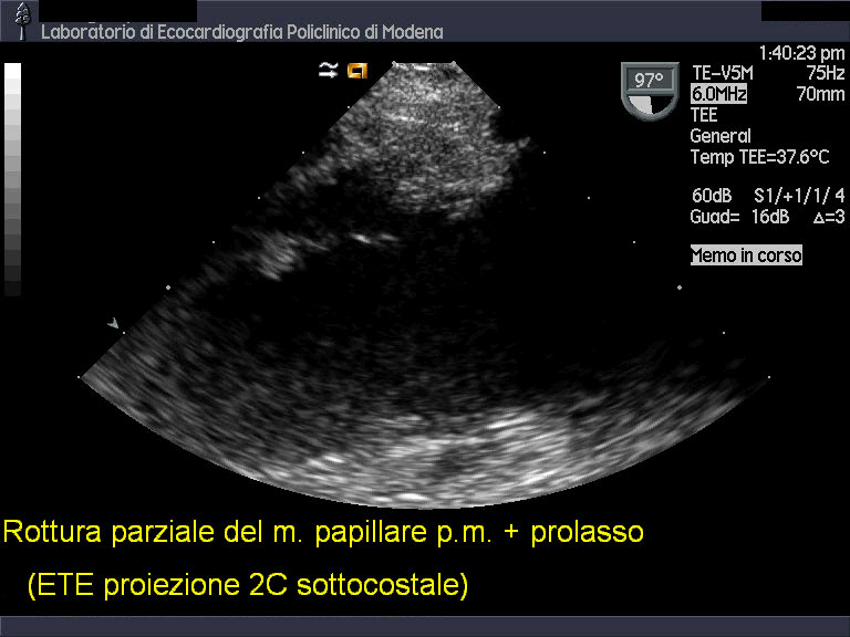Rottura di papillare