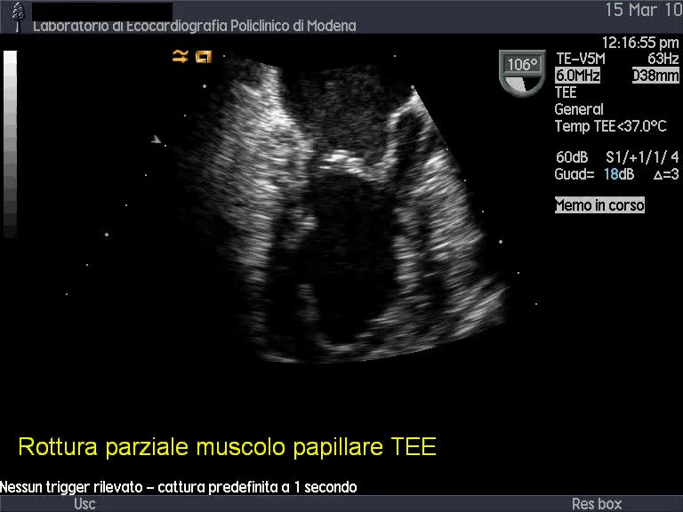 Stemi complicato da rottura parziale del muscolo papillare postero-mediale