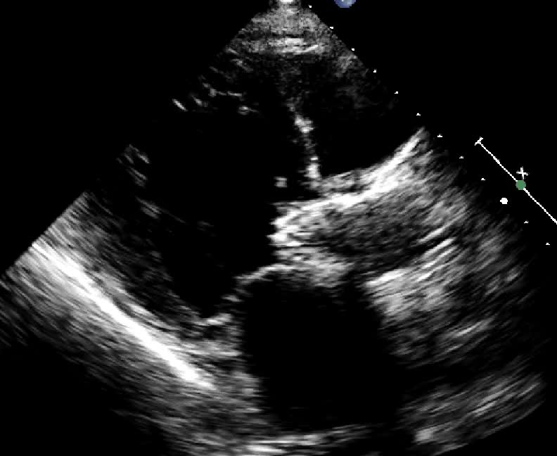 Malposizionamento di TAVI