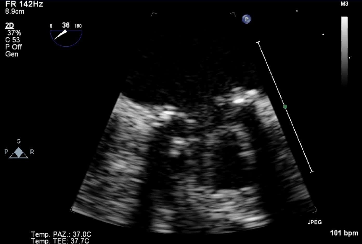 Malfunzionamento di protesi