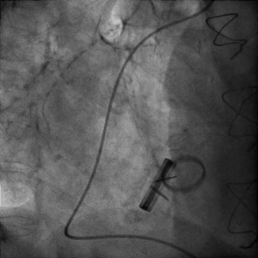 Malfunzionamento di protesi