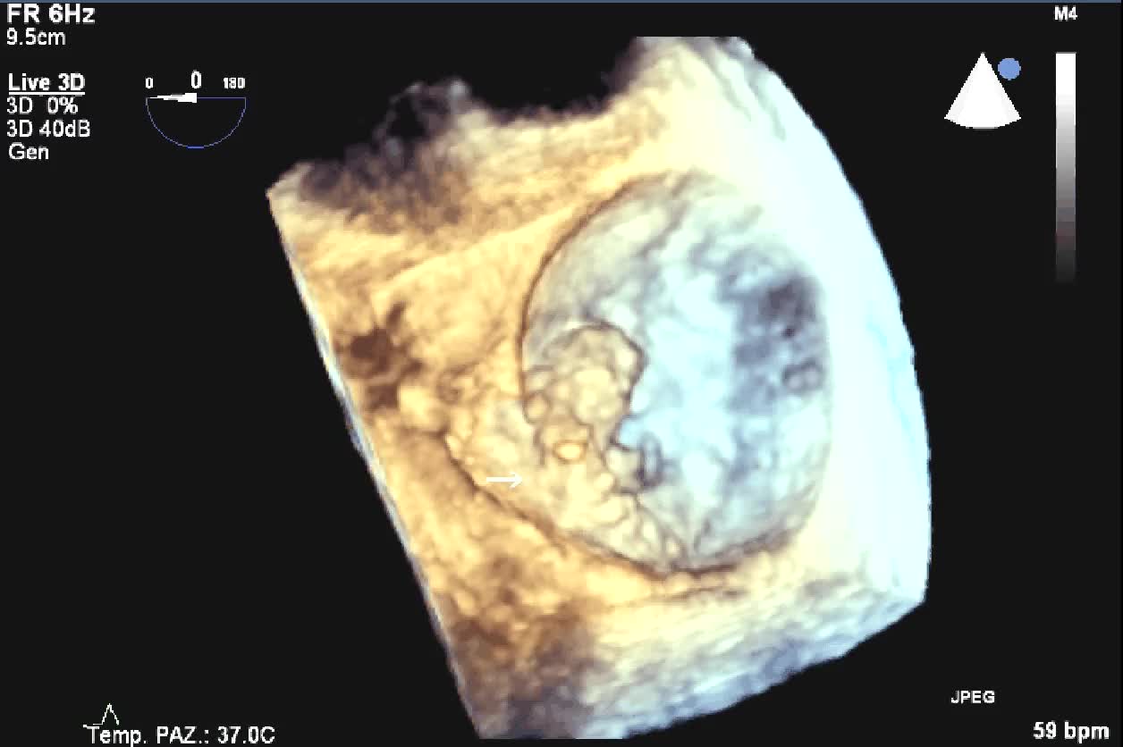 Distacco di protesi meccanica mitralica da endocardite infettiva
