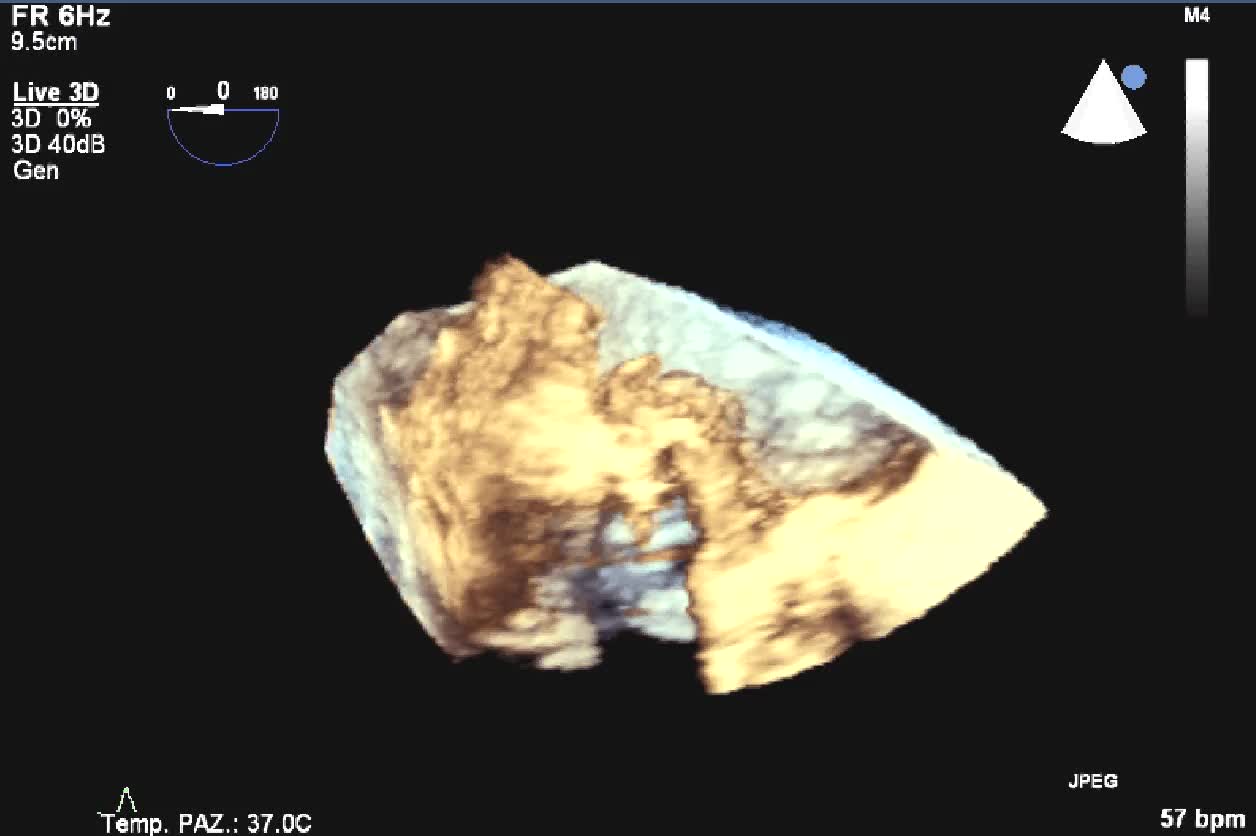 Distacco di protesi meccanica mitralica da endocardite infettiva con severo rigurgito paraprotesico