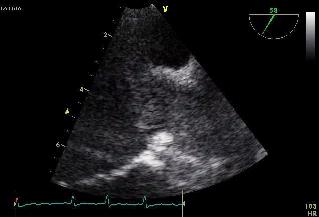 Trombo fluttuante in auricola sinistra