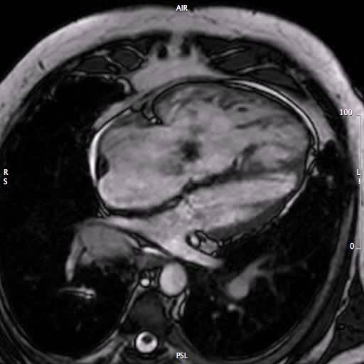 ITR e ipertensione polmonare