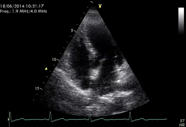 Shunt non causato da FOP