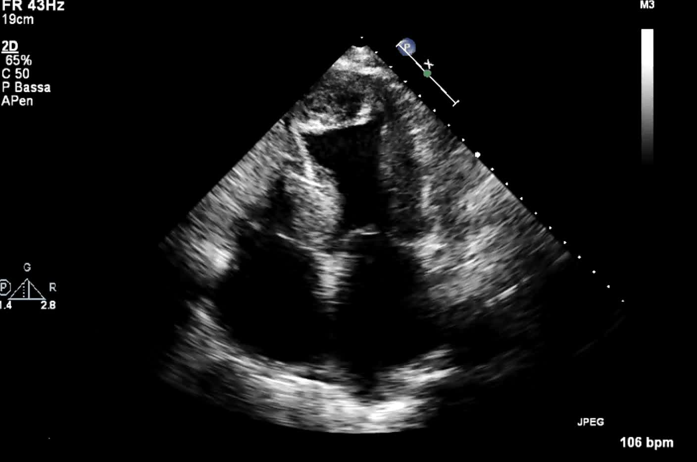 Cardiomiopatia ipertrofica