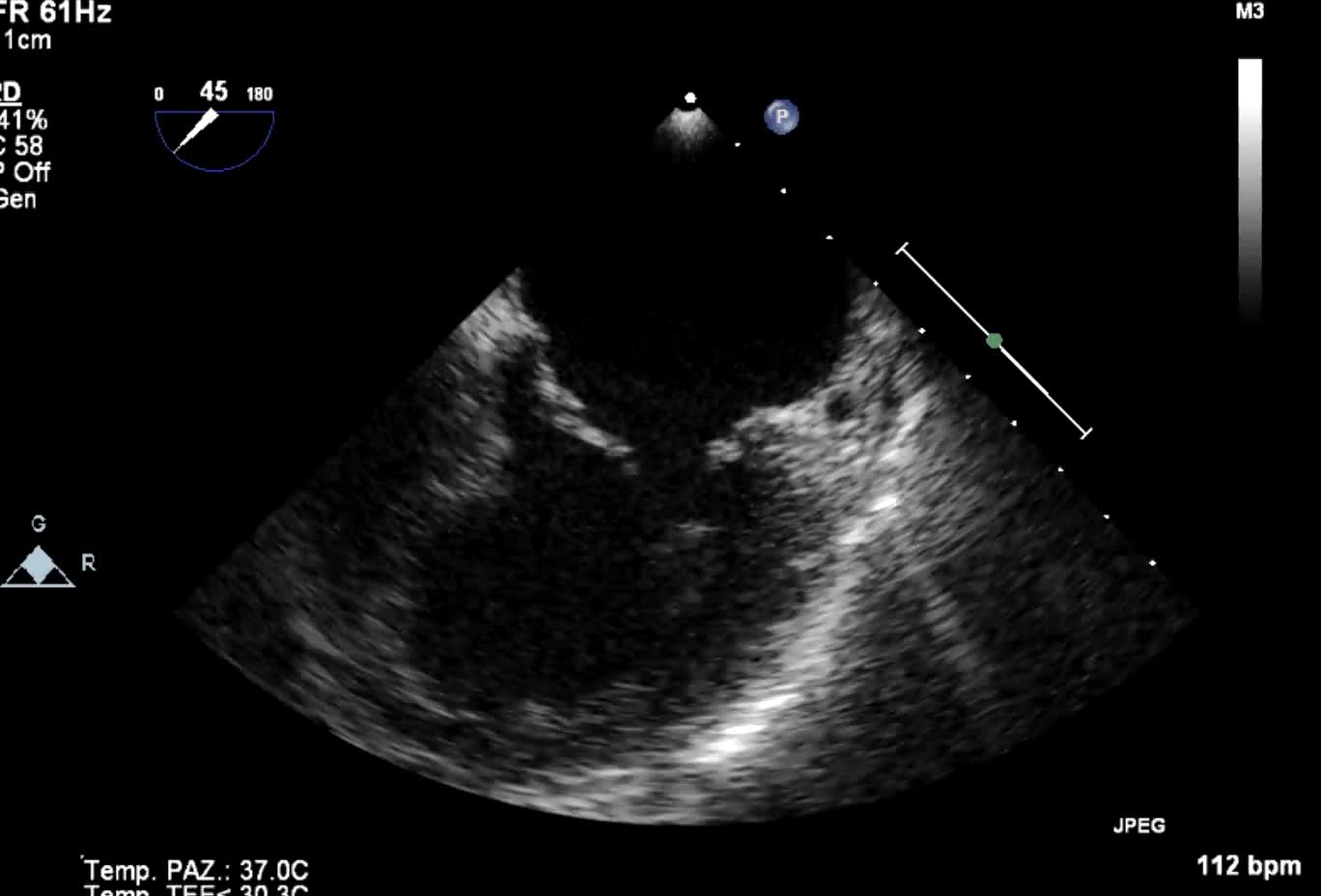 Cardiopatia ischemica