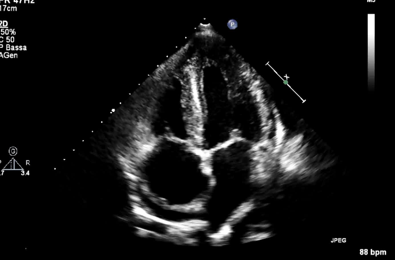 Scompenso cardio circolatorio