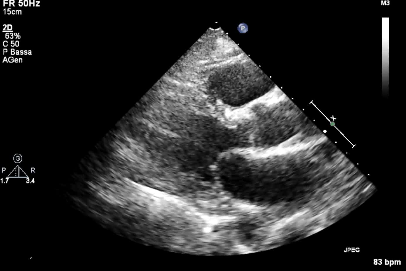 Catetere stimolatore nel ventricolo sinistro