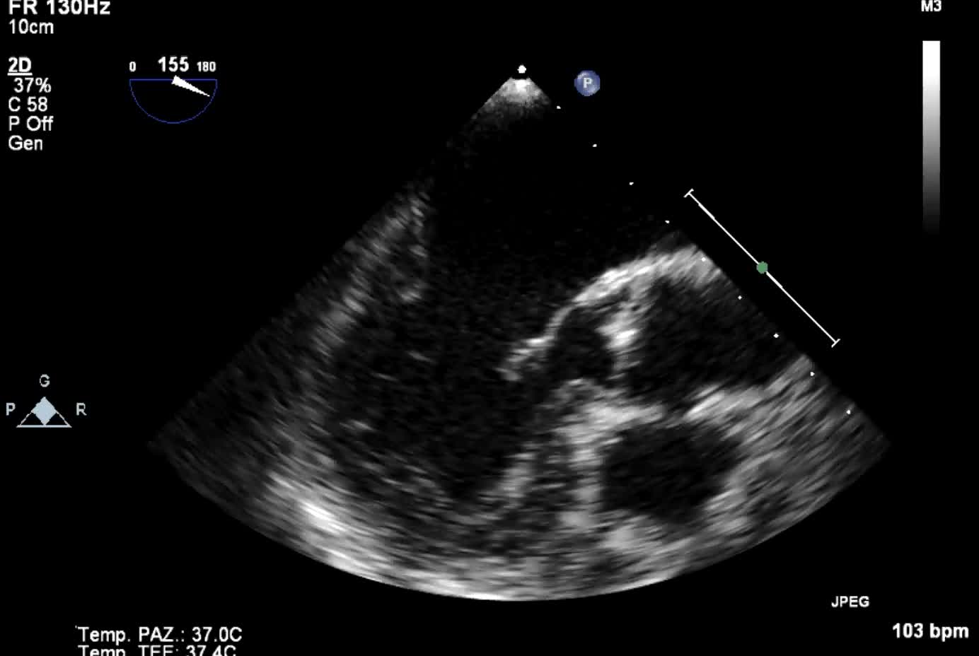 Rottura di papillare