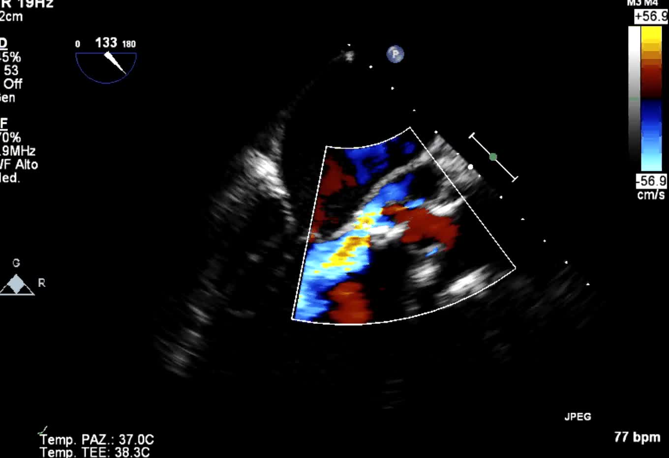 Pseudoaneurisma periprotesico