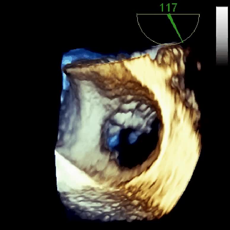 Prolasso valvolare mitralico