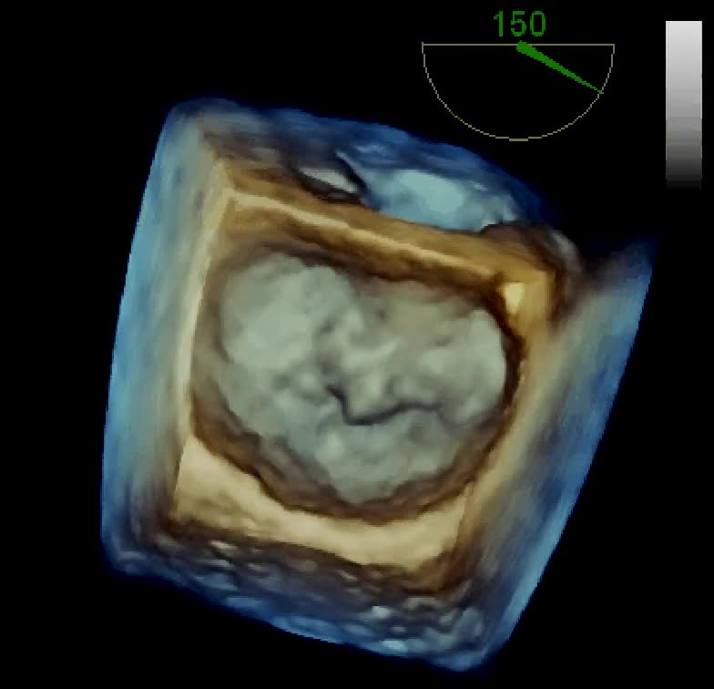 Prolasso valvolare mitralico