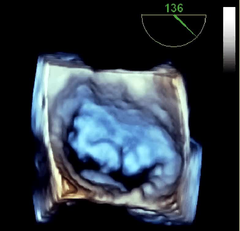 Insufficienza mitralica da rottura cordale