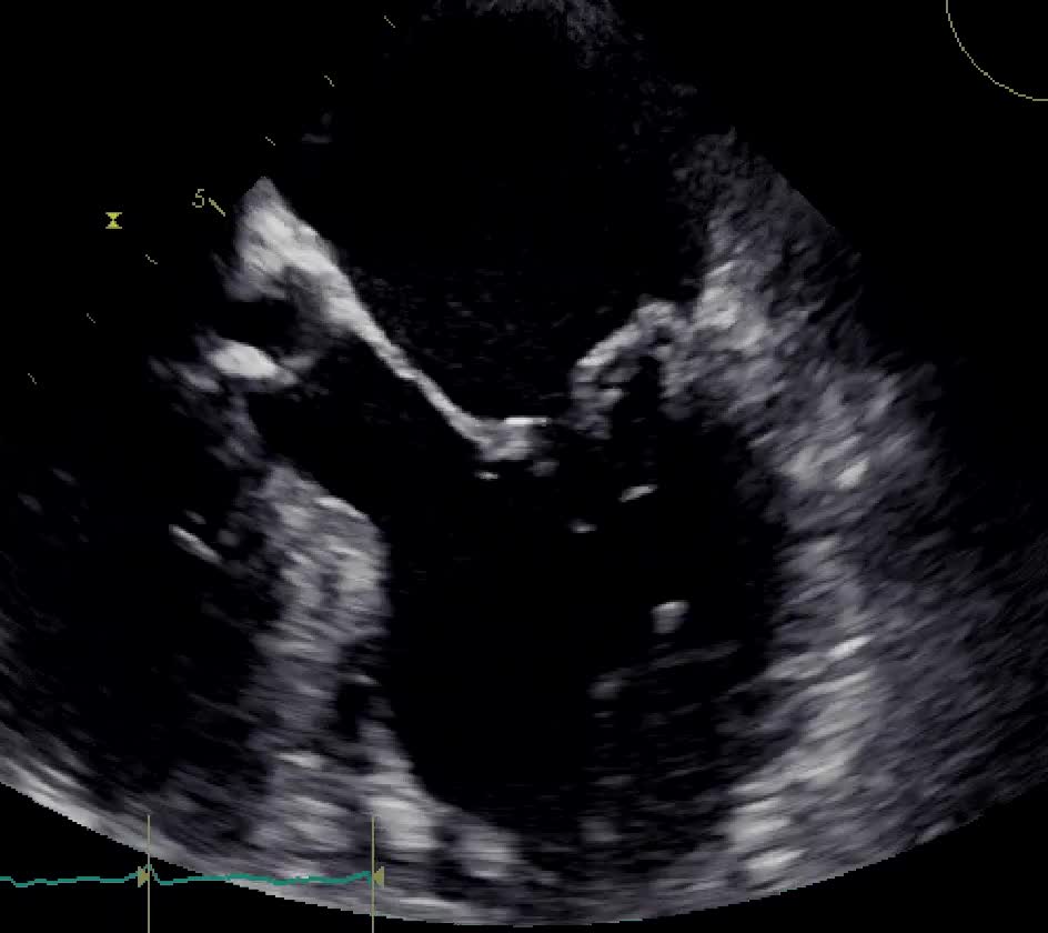 Insufficienza mitralica da rottura cordale