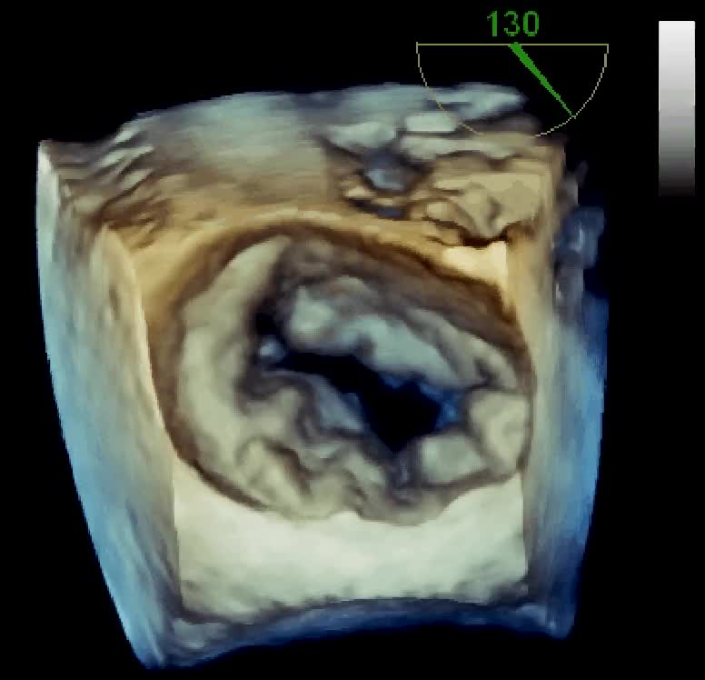 Insufficienza mitralica da rottura cordale