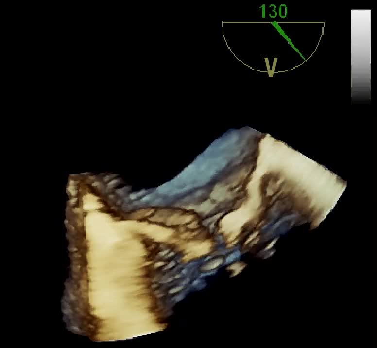 Insufficienza mitralica da rottura cordale