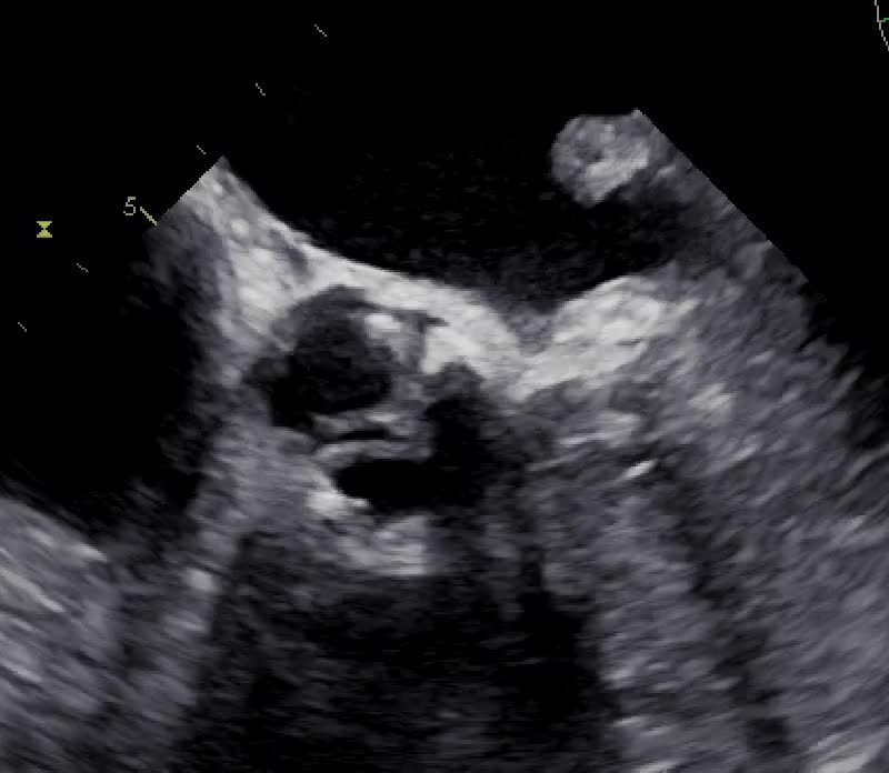 Stenosi aortica moderata