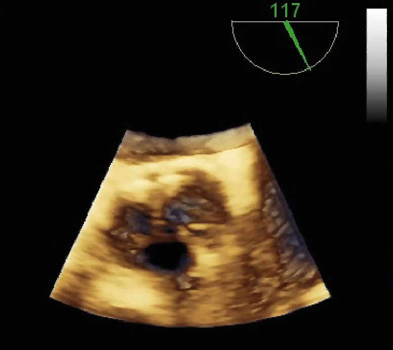 Stenosi aortica moderata
